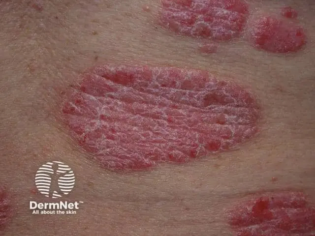 Example of chronic plaque psoriasis