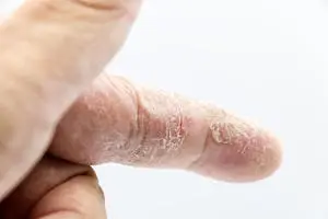 cracked-damaged skin