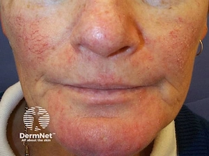 Rosacea Skin Image - Courtsey of DermNet