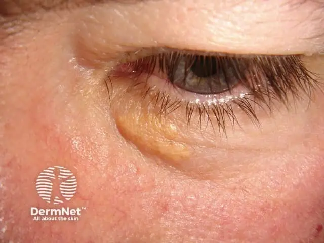 Example of Xanthoma around eye